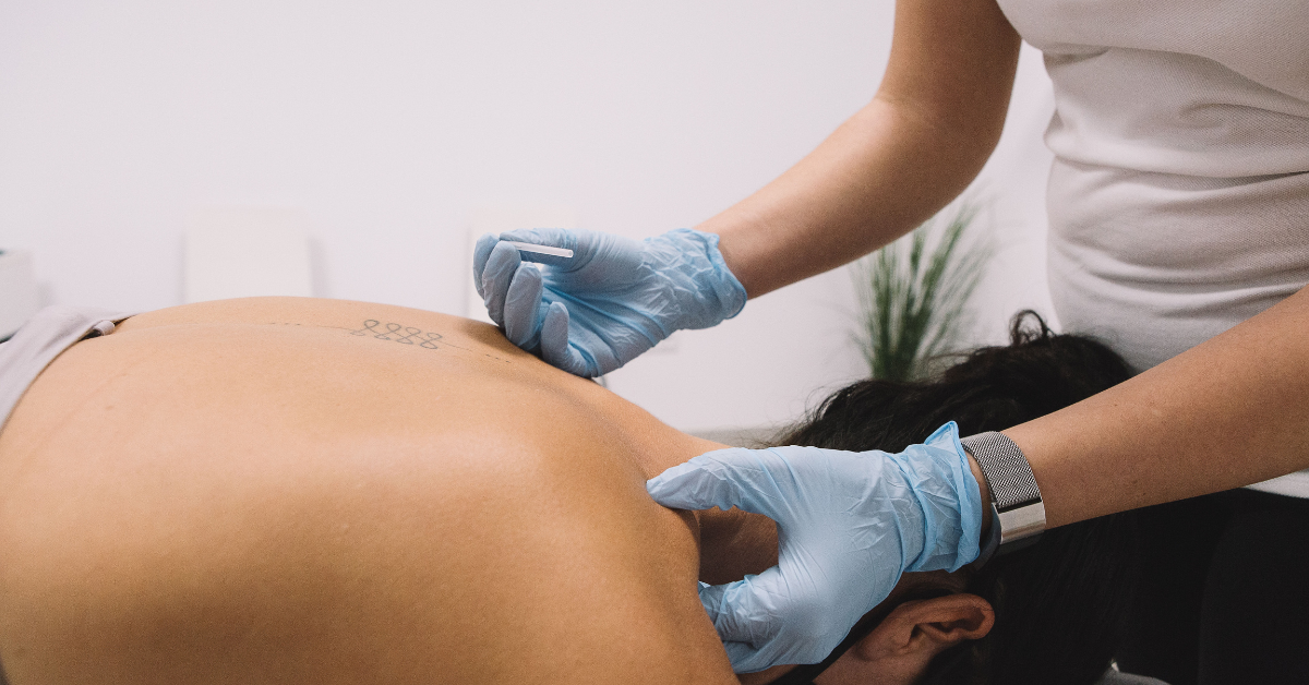 Professional dry needling treatment at Sport & Spine in Marshfield, WI targeting a woman's neck and back muscles.